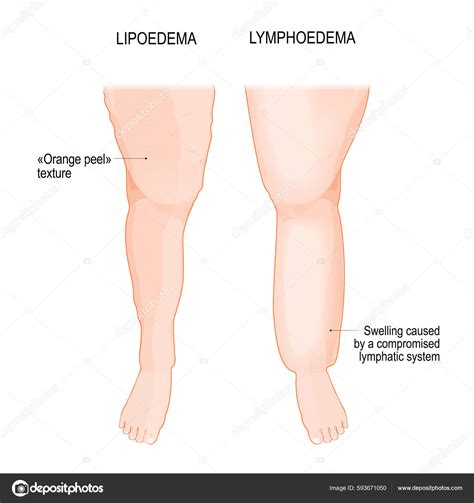 Ilustración comparativa entre lipedema y obesidad común