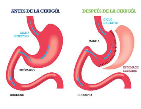 Esquema anatómico del estómago antes y después de la manga gástrica, mostrando la reducción de tamaño y la forma tubular.