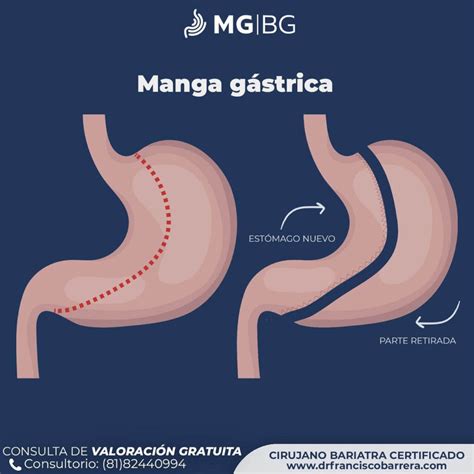 Diagrama del procedimiento laparoscópico de la manga gástrica, mostrando las incisiones y la resección del estómago.
