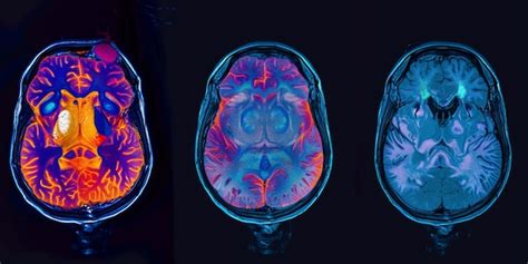 Imagen de resonancia magnética cerebral mostrando atrofia en diferentes áreas