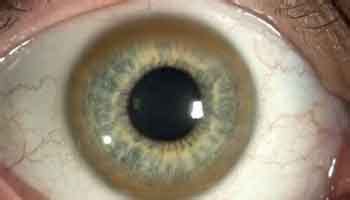 Ilustración del anillo de Kayser-Fleischer en la córnea