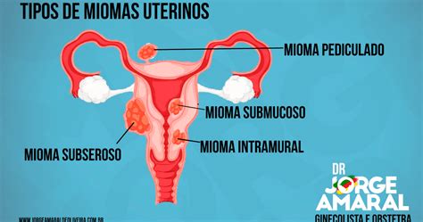 Representación esquemática del útero mostrando la ubicación de los miomas uterinos.