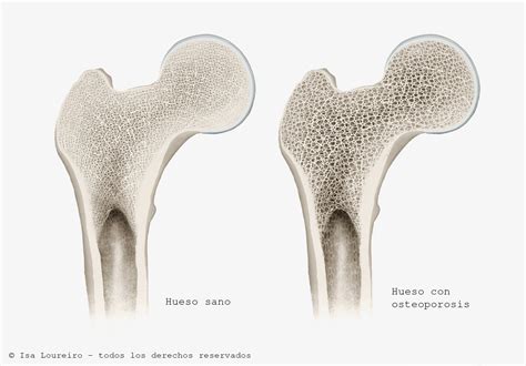 Ilustración que compara un hueso sano con un hueso osteoporótico.