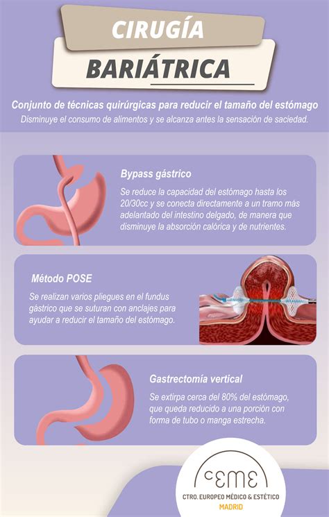 Diagrama mostrando los diferentes tipos de procedimientos de reducción de estómago sin cirugía (POSE, TORe, Balón Intragástrico, Endomanga).