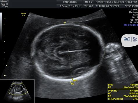 Ecografía fetal mostrando las mediciones de crecimiento