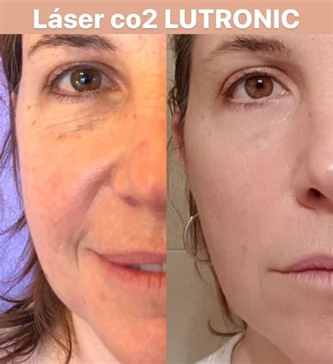 Comparativa visual del antes y después del tratamiento con Láser CO2 fraccionado en cicatrices o arrugas.