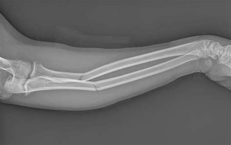 Radiografía de una fractura ósea.