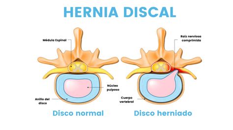diagrama que ilustra una hernia discal y la presión sobre un nervio