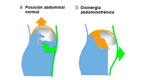 Infografía comparativa de la anatomía abdominal antes y después del embarazo, mostrando la distensión muscular.