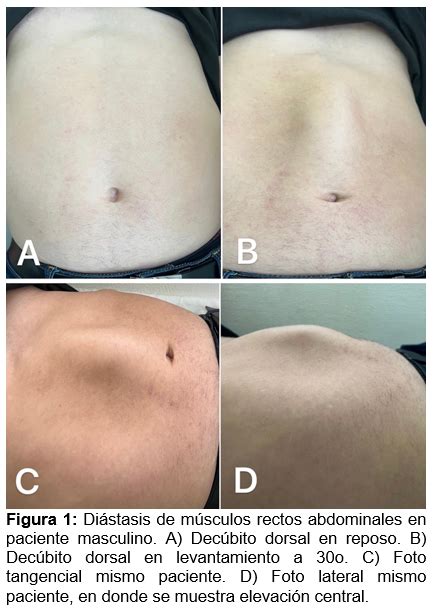 Diagrama anatómico mostrando la línea alba y los músculos rectos abdominales, indicando la zona de separación en la diástasis.
