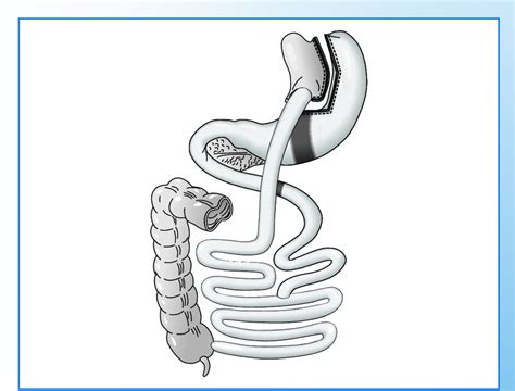 Ilustración del procedimiento de Bypass Gástrico en Y de Roux.