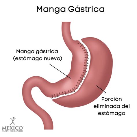 Esquema de la Manga Gástrica.
