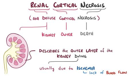 infografía mostrando los síntomas clave de la necrosis cortical renal, como dolor lumbar, orina oscura y fiebre