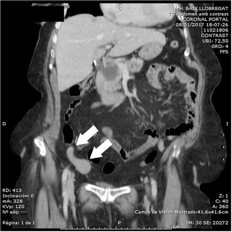 imagen de TC abdominal con contraste que muestra el 