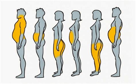 Ilustración anatómica mostrando las zonas comunes de acumulación de grasa en hombres, susceptibles de liposucción.