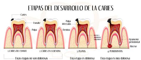 Ilustración de un diente con caries en diferentes etapas, desde desmineralización del esmalte hasta lesión cavitada en dentina.