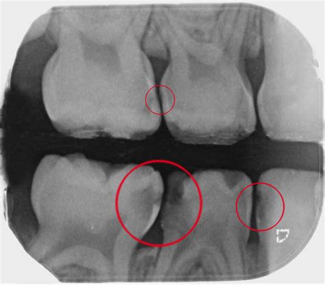 Radiografías de aleta de mordida mostrando diferentes grados de caries interproximal.