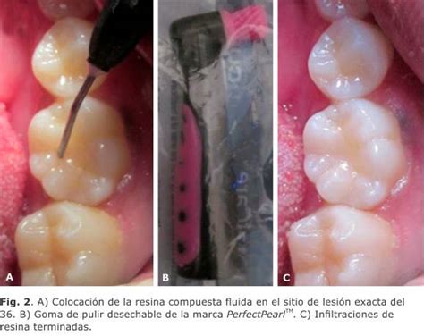 Microfotografía de una lesión de caries infiltrada con resina, mostrando el sellado de los túbulos dentinarios.