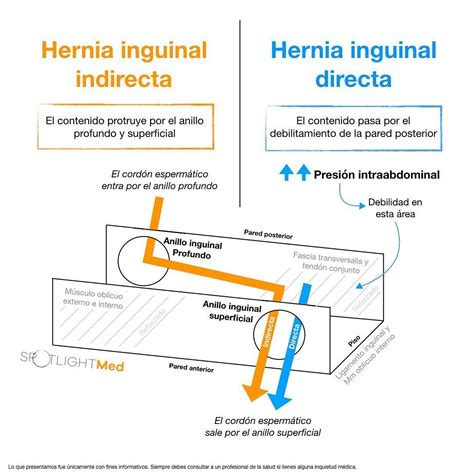 Diagrama mostrando la diferencia entre hernia inguinal directa e indirecta.