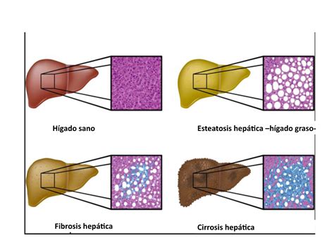 Diagrama del hígado mostrando la acumulación de grasa (esteatosis) y los efectos del estrés oxidativo.