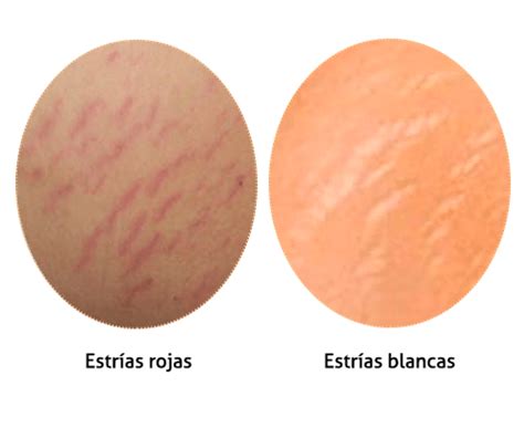 Gráfico comparativo de la estructura de la piel con estrías rojas y blancas.