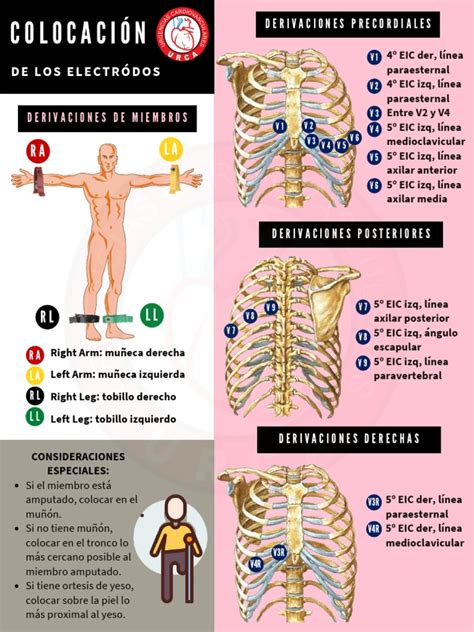 Diagrama que ilustra la colocación de los electrodos para electroestimulación en diferentes partes del cuerpo.