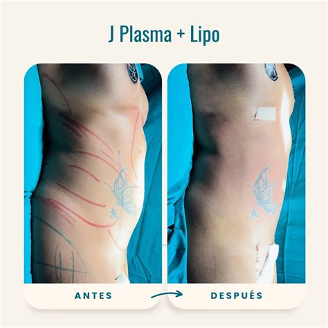 Galería de antes y después de lipoescultura HD mostrando transformaciones de pacientes.