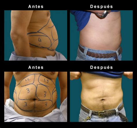 Fotografías de antes y después de liposucción abdominal en mujeres, mostrando reducción de grasa.