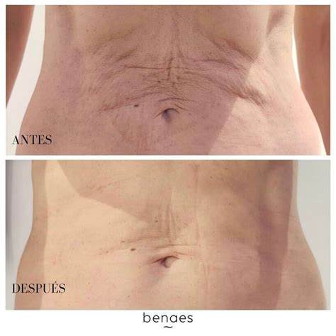 infografía comparativa de tratamientos para la flacidez de la piel