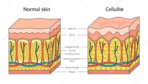 Ilustración anatómica mostrando la estructura de la celulitis bajo la piel