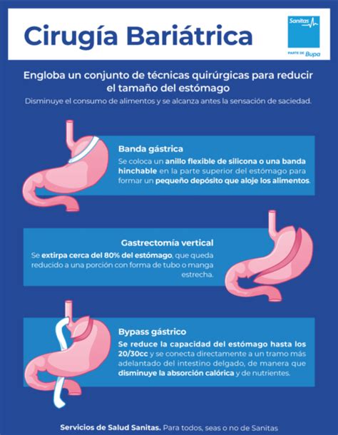 Infografía comparativa de los diferentes tipos de cirugía bariátrica