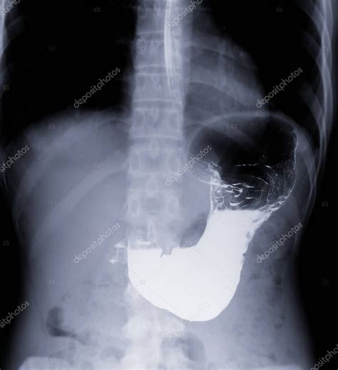 Radiografía de contraste mostrando el estómago y el intestino delgado para evaluar el tránsito digestivo.