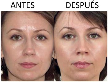 Comparativa visual de la piel antes y después de la mesoterapia facial con vitaminas.