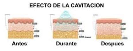 Infografía sobre las principales contraindicaciones de la cavitación.