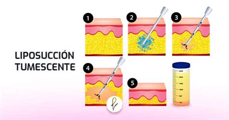 Representación esquemática de la liposucción tradicional con cánula.