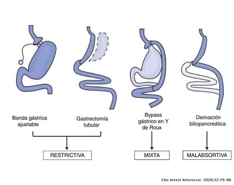 Gráfico comparativo de las principales técnicas de cirugía bariátrica: restrictivas, malabsortivas y mixtas.