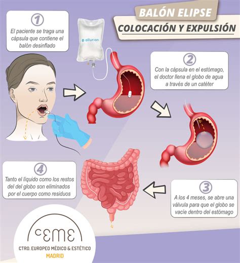 Infografía comparativa de balón gástrico ingerible y endoscópico, mostrando los métodos de colocación y extracción.