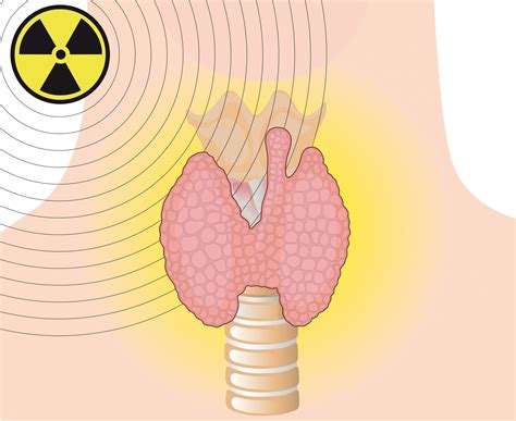 Diagrama esquemático que muestra la administración de yodo radioactivo y su absorción por la glándula tiroides.
