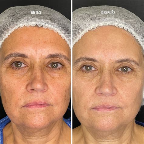 fotografía de antes y después de un tratamiento de lipólisis láser en el abdomen