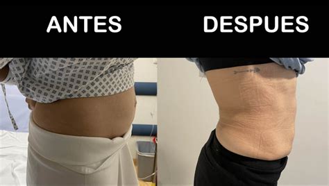 Comparativa de la apariencia del abdomen antes y después de una abdominoplastia, mostrando la reducción de piel y grasa.