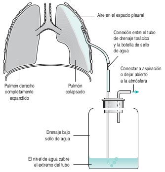 Diagrama de un drenaje torácico con tubo y sello de agua