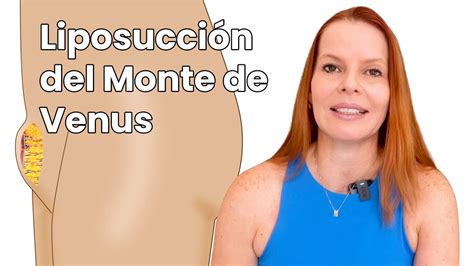 Diagrama que muestra la combinación de liposucción del Monte de Venus con otros procedimientos estéticos abdominales y genitales.