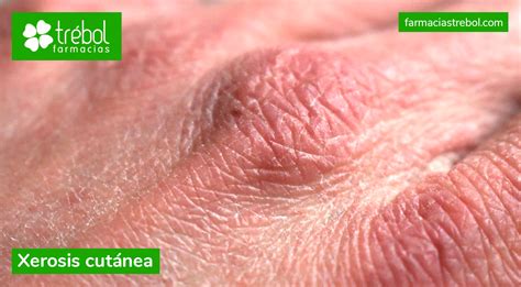 Fotografía de piel con lanugo y xerosis, características de la anorexia nerviosa.