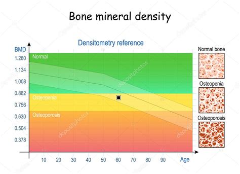 Gráfico comparativo de densidad mineral ósea en pacientes con anorexia nerviosa frente a controles sanos.