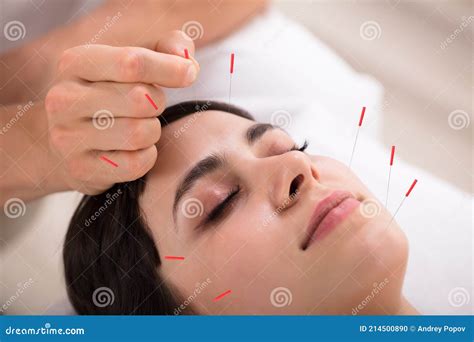 imagen de una persona recibiendo tratamiento de acupuntura