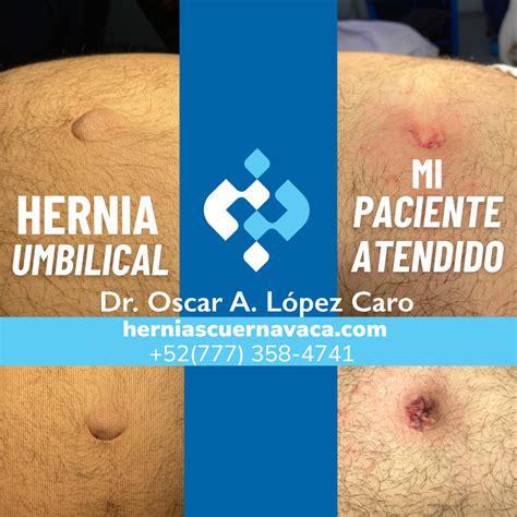 Ilustración anatómica mostrando la ubicación de una hernia umbilical.