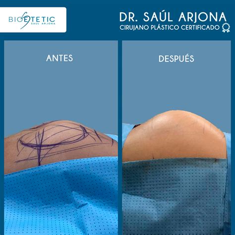 Infografía comparativa de lipotransferencia vs. implantes de glúteos, destacando beneficios y consideraciones.