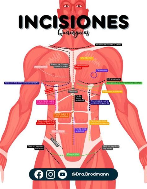 Diagrama de las incisiones y áreas de trabajo en una abdominoplastia clásica.