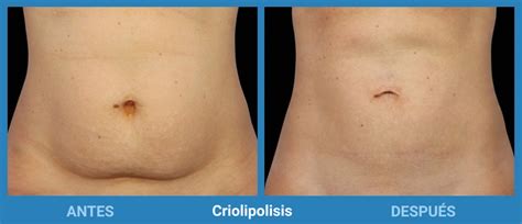 Imagen ilustrativa de la aplicación de Criolipólisis en el abdomen