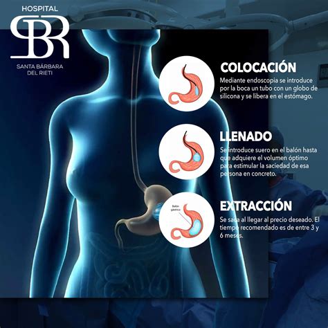 Gráfico comparativo de pérdida de peso promedio con balón gástrico.